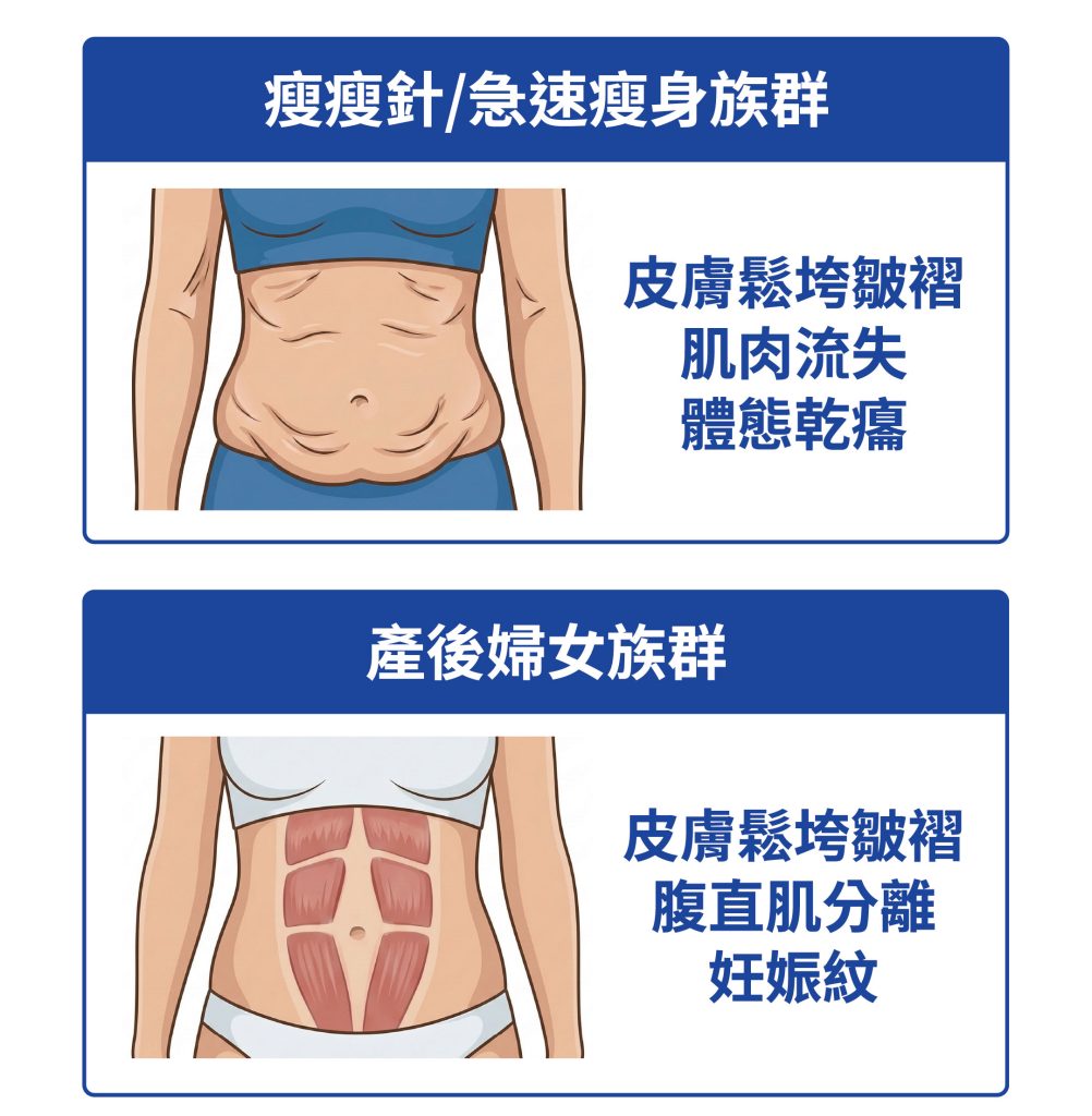 瘦瘦針族群皮膚鬆垮與肌肉流失；產後婦女腹直肌分離與妊娠紋。